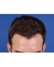 After Hair Transplant&nbsp;Hairlines